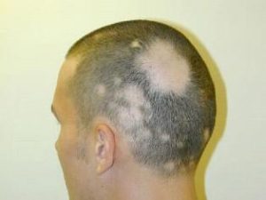 alopecia areata